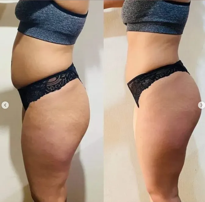 Fotos de seguimiento (antes y después) del abdomen de una paciente de Consultorios DAG en manejo de peso, de perfil