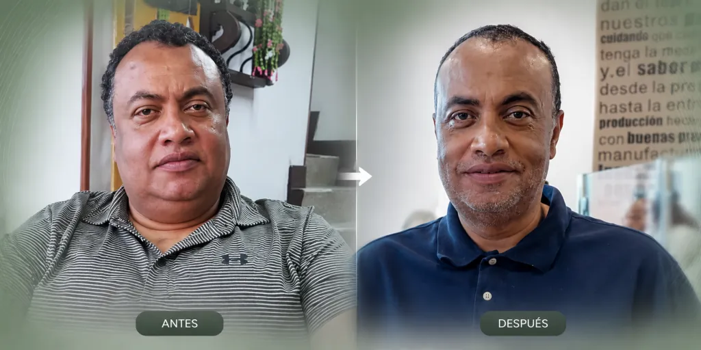 Fotos de seguimiento (antes y después) de un paciente de Consultorios DAG: Pérdida de peso