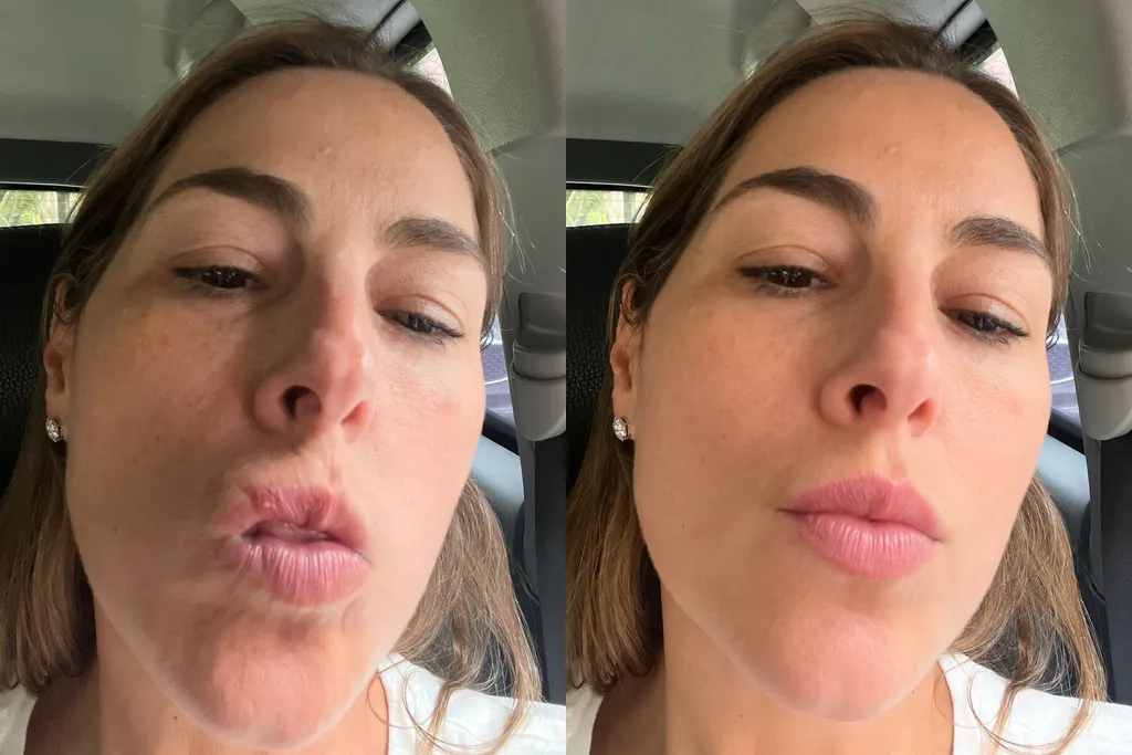 Fotos de seguimiento de una paciente de Consultorios DAG: herpes labial
