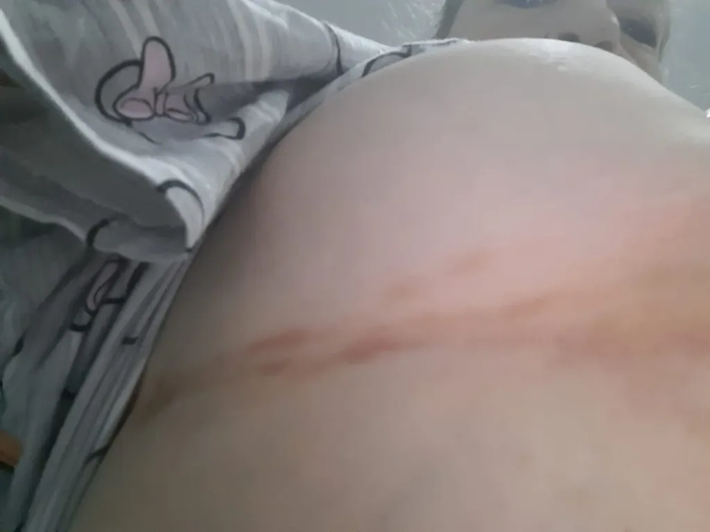 Foto de seguimiento de un paciente de Consultorios DAG: herpes zóster