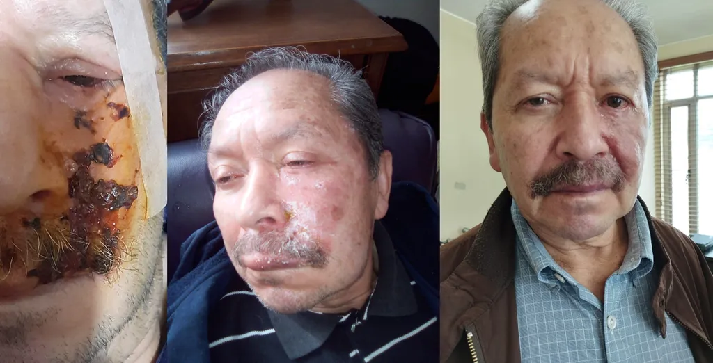 Fotos de seguimiento de un paciente de Consultorios DAG: herpes zóster